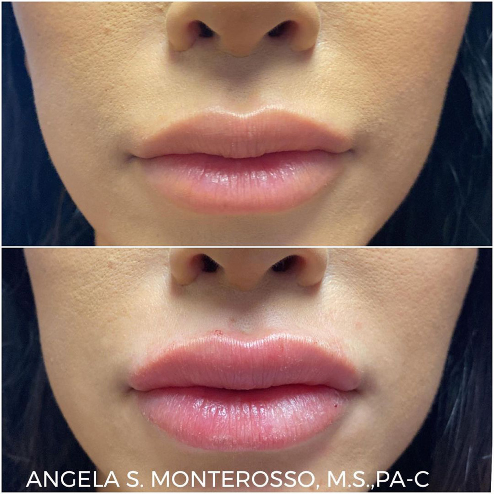 Real patient Lip Augmentation by ECA Plastic Surgery, New Jersey