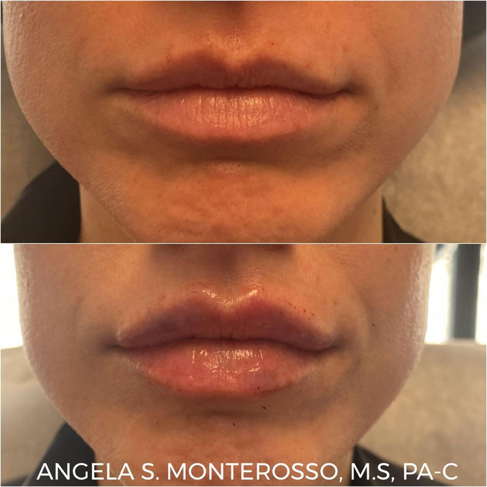 Real patient Lip Augmentation by ECA Plastic Surgery, New Jersey