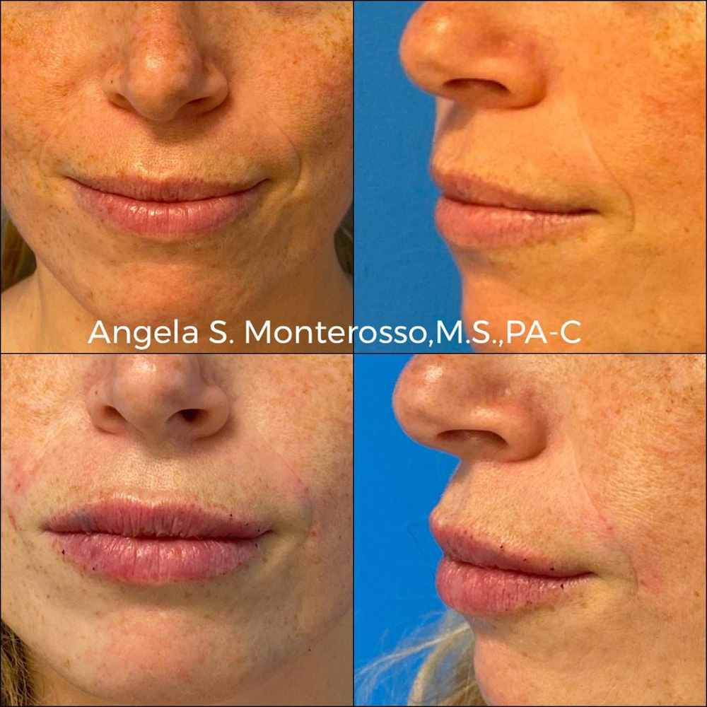 Real patient Lip Augmentation by ECA Plastic Surgery, New Jersey