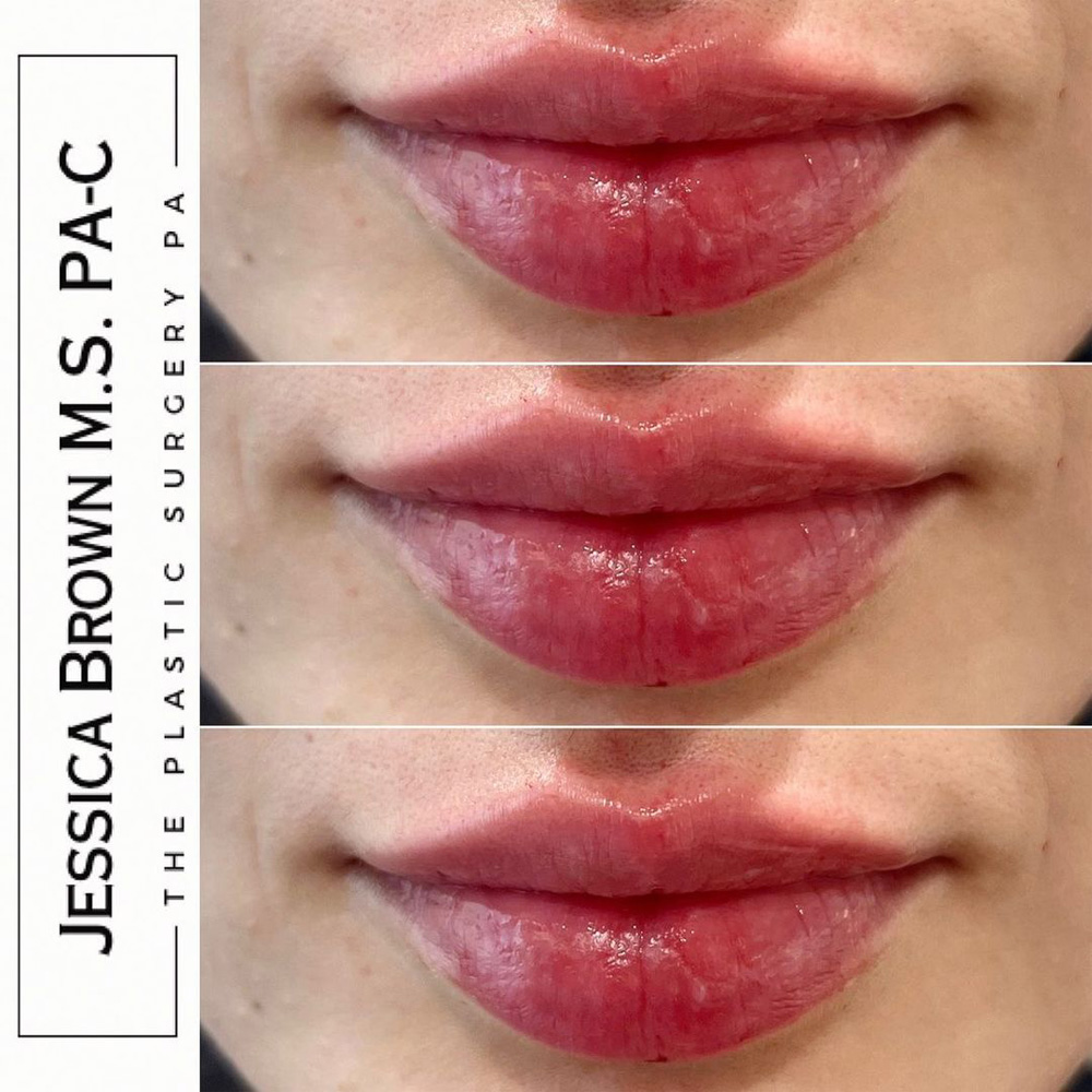 Real patient Lip Augmentation by ECA Plastic Surgery, New Jersey