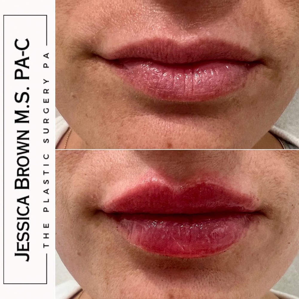 Real patient Lip Augmentation by ECA Plastic Surgery, New Jersey