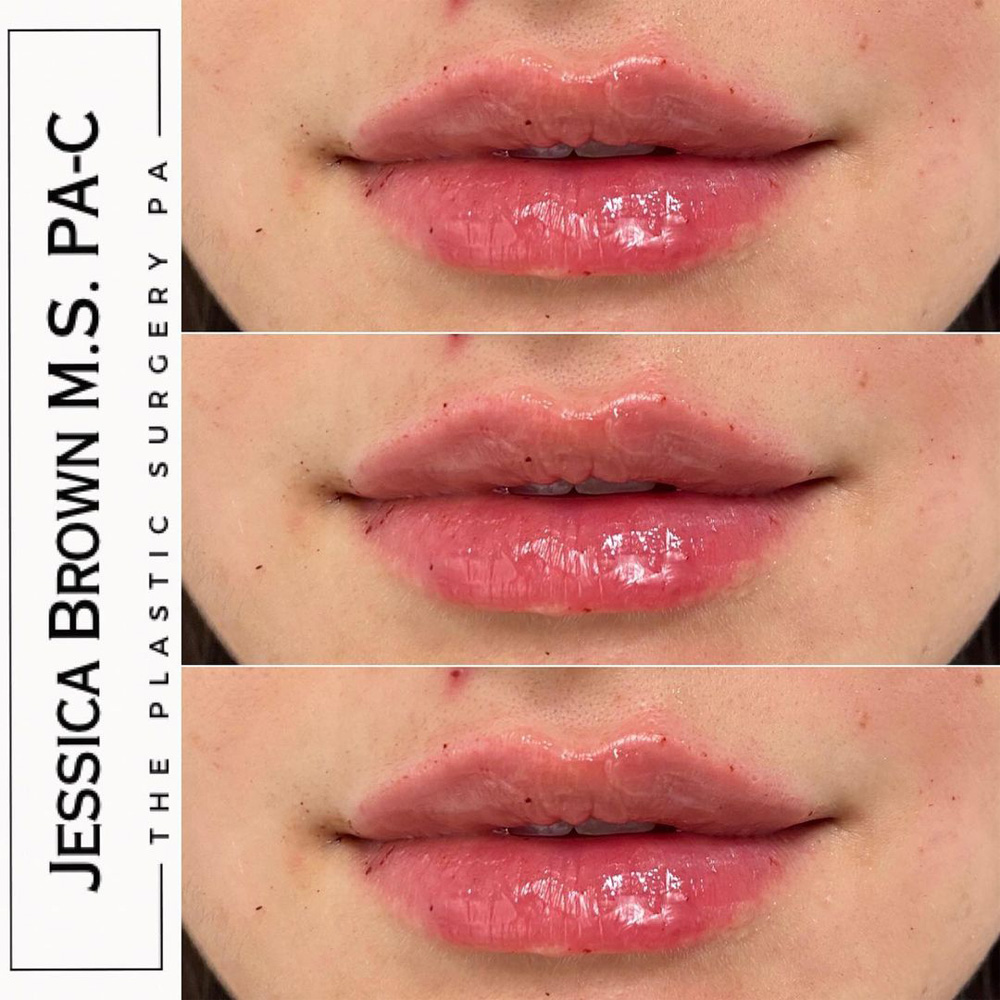 Real patient Lip Augmentation by ECA Plastic Surgery, New Jersey