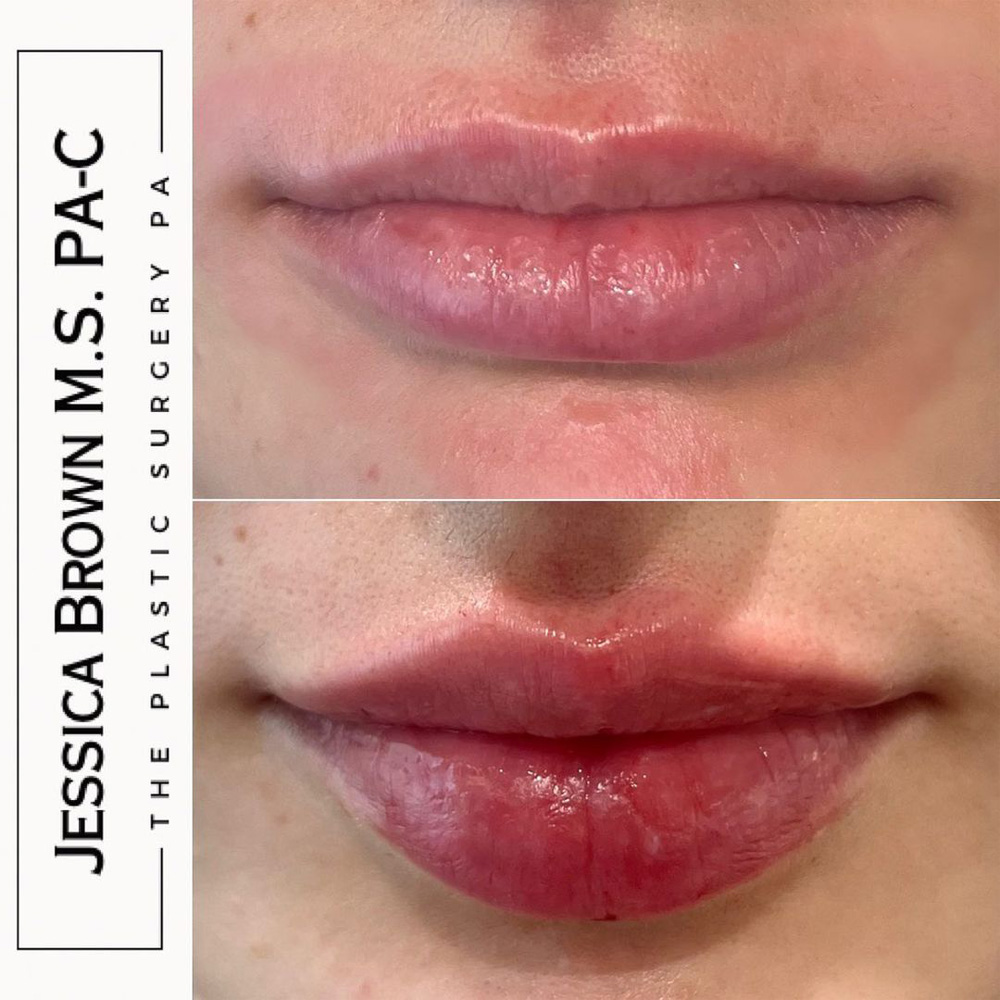 Real patient Lip Augmentation by ECA Plastic Surgery, New Jersey