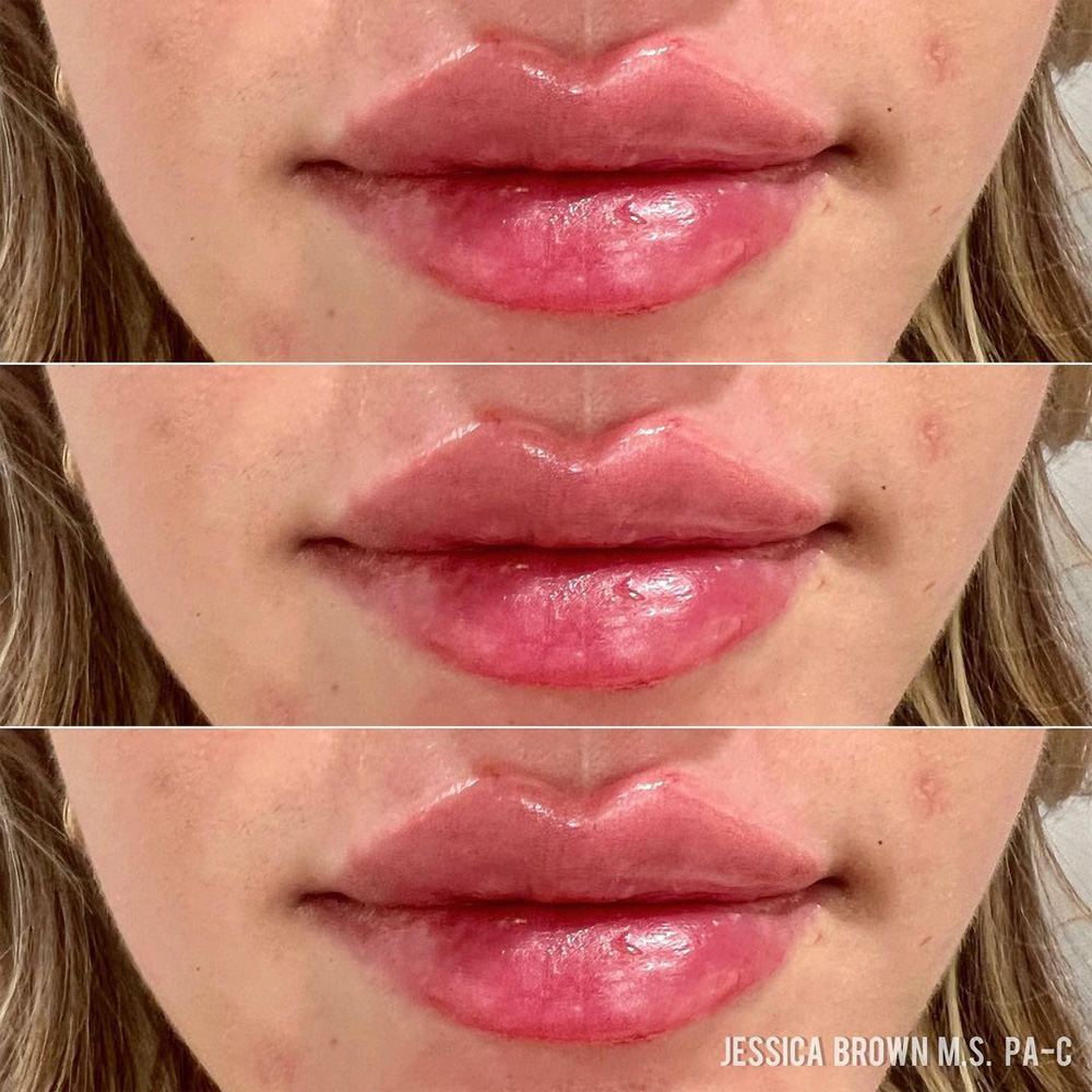 Real patient Lip Augmentation by ECA Plastic Surgery, New Jersey