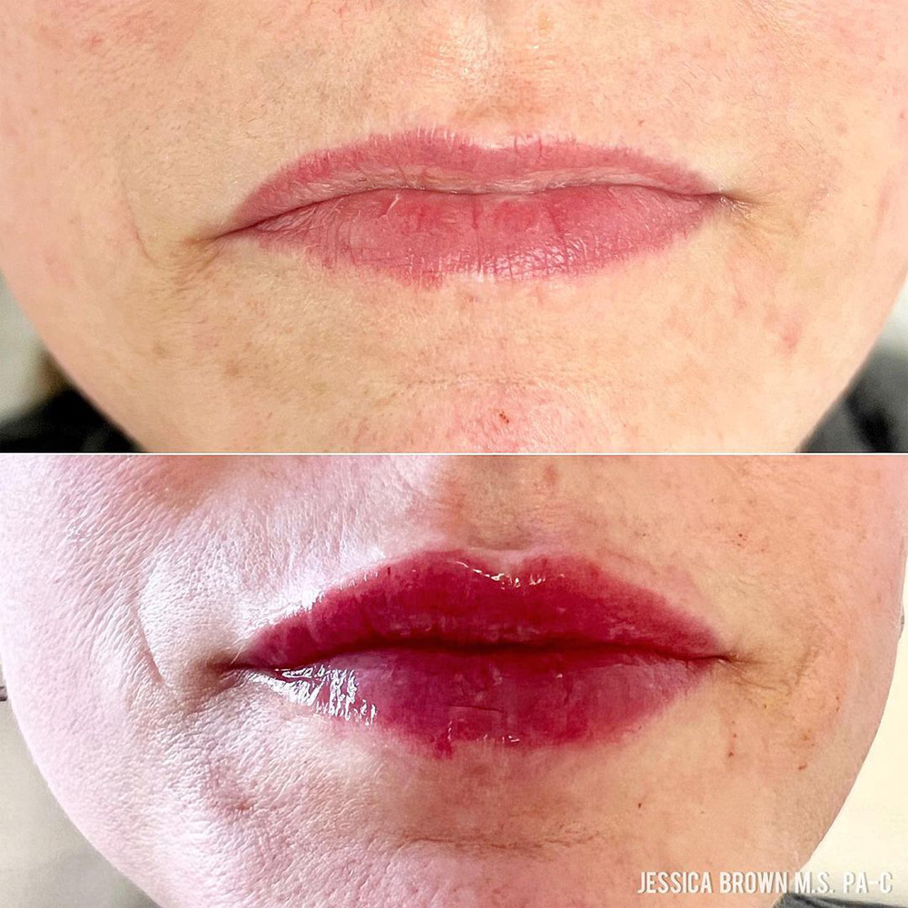 Real patient Lip Augmentation by ECA Plastic Surgery, New Jersey