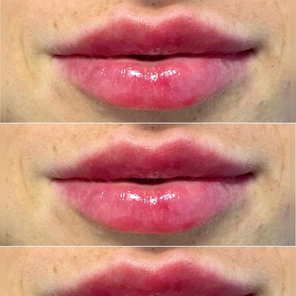 Real patient Lip Augmentation by ECA Plastic Surgery, New Jersey