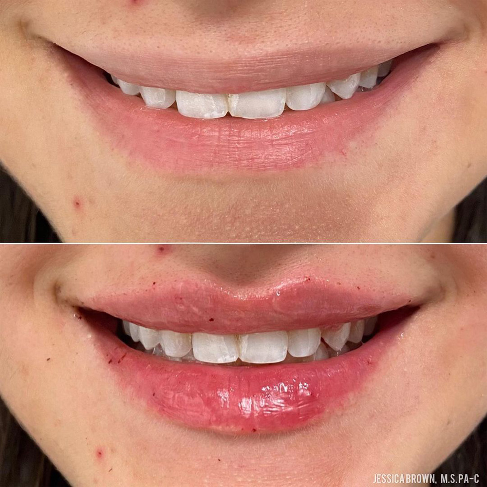 Real patient Lip Augmentation by ECA Plastic Surgery, New Jersey