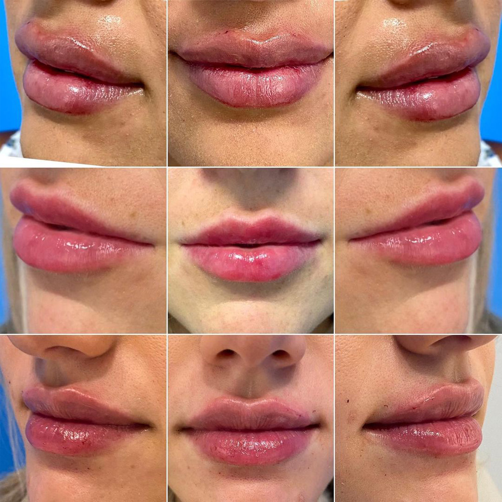 Real patient Lip Augmentation by ECA Plastic Surgery, New Jersey