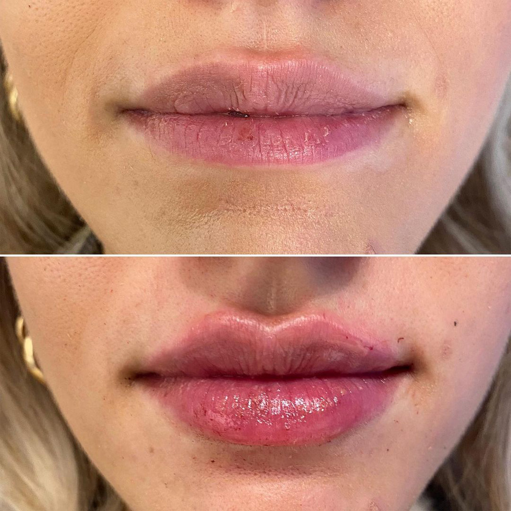 Real patient Lip Augmentation by ECA Plastic Surgery, New Jersey