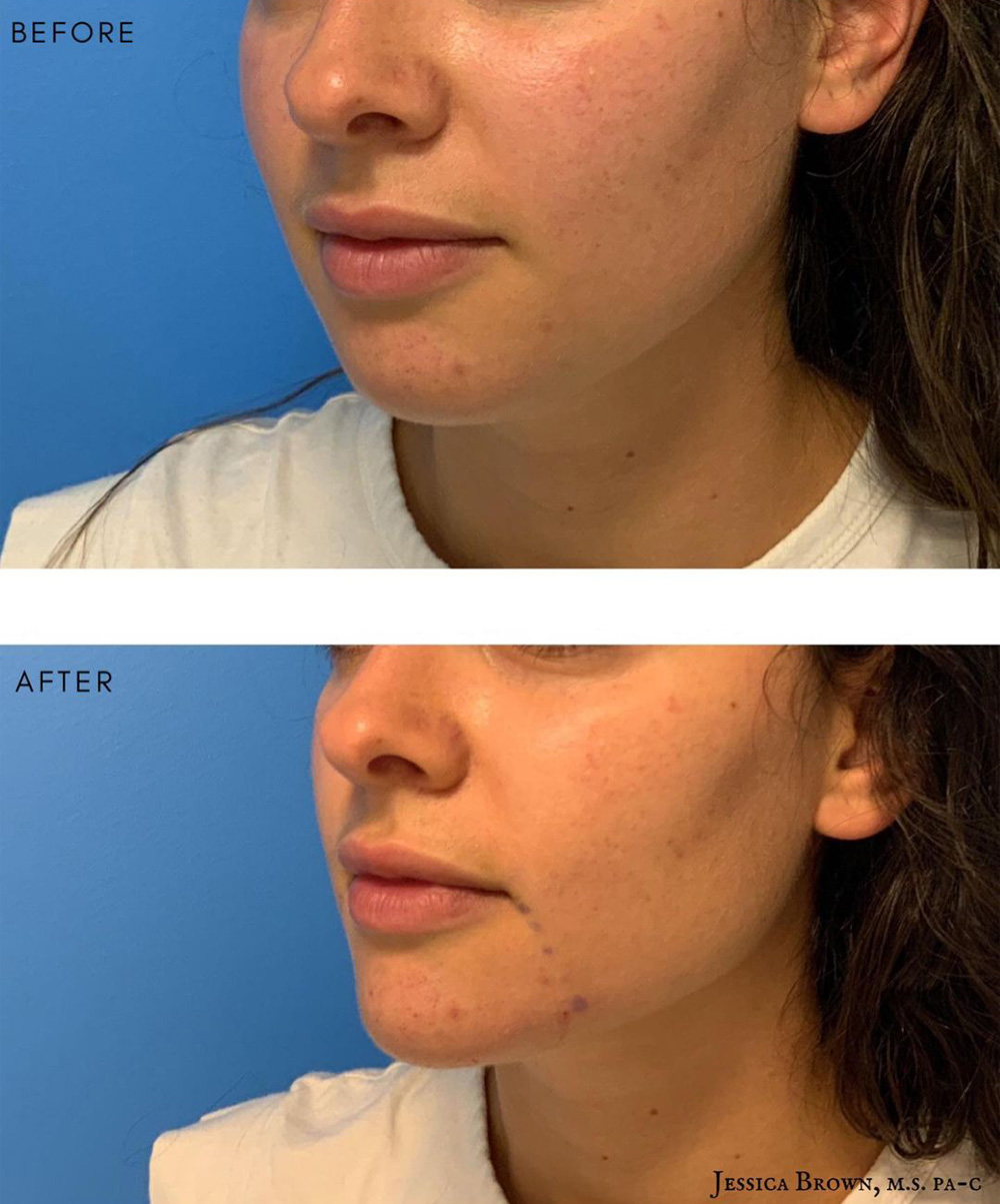 Real patient Lip Augmentation by ECA Plastic Surgery, New Jersey