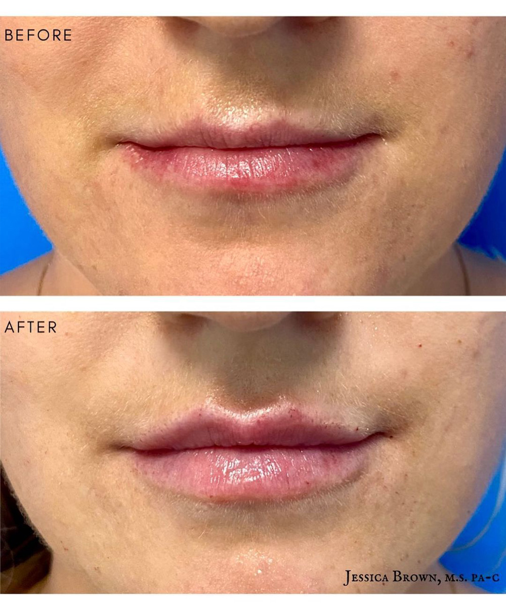 Real patient Lip Augmentation by ECA Plastic Surgery, New Jersey
